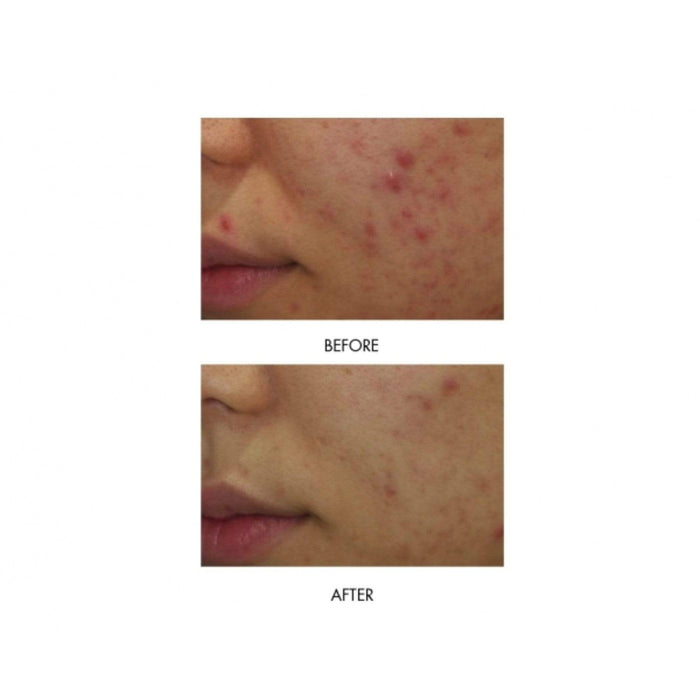 MIRENESSE ACNE 40g / 1.4oz Power Clear D-Blemish Treatment Gel Mini Kit X4  - Acne + Rosacea