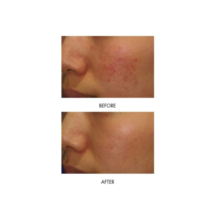 MIRENESSE ACNE 40g / 1.4oz Power Clear D-Blemish Treatment Gel Mini Kit X4  - Acne + Rosacea