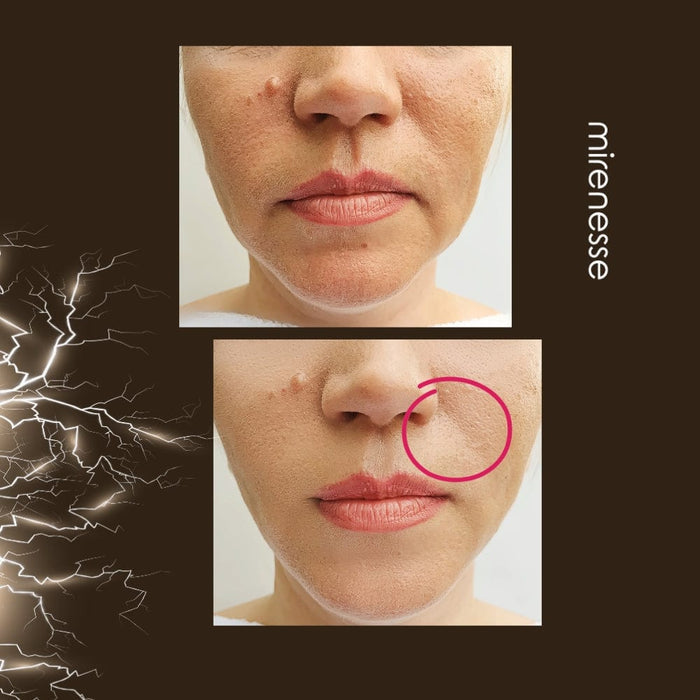 Mirenesse Skincare Power Lift Face Fitness 8 In 1 Microcurrent| Ems Device