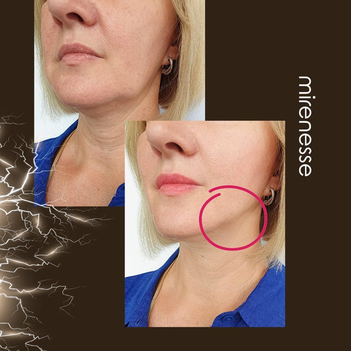 Mirenesse Skincare Power Lift Face Fitness 8 In 1 Microcurrent| Ems Device